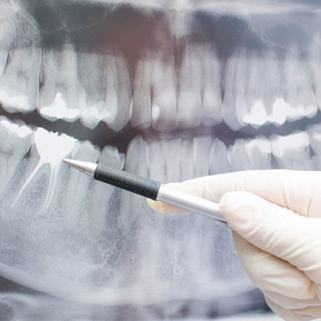 An image of a dental x-ray.