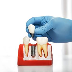 dental implants Windsor, ON